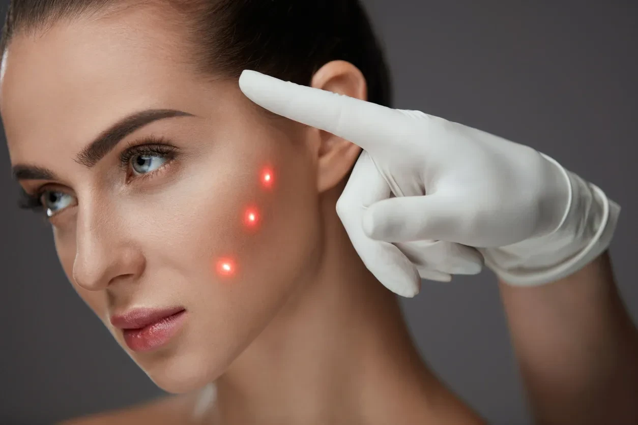 Laser skin treatment with red light therapy
